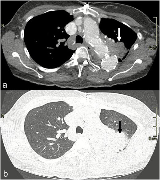 CT scan image with dissection protocol of the left upper lobe consolidation (arrow) on (a) mediastinal and (b) lung windows.