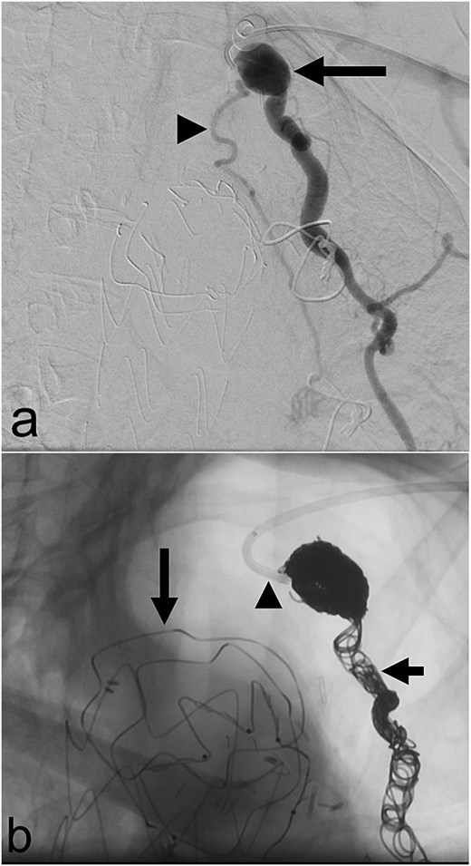 (a) Aneurysmal left internal mammary artery (arrow) with bronchial collateral (arrowhead) on digital subtraction angiography; (b) selective catheterization of the origin of the left internal mammary artery (arrowhead) via a left radial arterial approach with coil embolization of the left internal mammary artery (short arrow) and a thoracic aortic endograft (long arrow) on fluoroscopy.