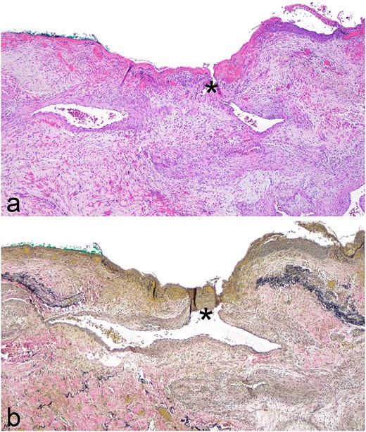 Photomicrographs of fistula between airway and small bronchial artery (*) from lobectomy specimen; (a) Hematoxylin and eosin stain, original magnification ×400; (b) elastic stain, original magnification ×400.