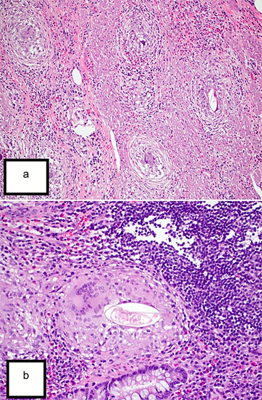 (a) Hematoxylin and eosin (H&E) stain (10×) revealed the appendix shows diffuse mucosal and focally transmural granulomatous inflammation surrounding Bilharizial ova. (b) H&E stain (40×) revealed the appendix shows diffuse mucosal and focally transmural granulomatous inflammation surrounding Bilharizial ova.