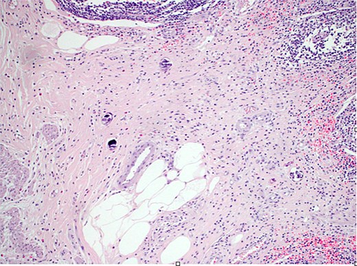 H&E stain (10×) revealed the appendix shows focal submucosal deposition of Bilharizial ova with focal granulomatous inflammation.