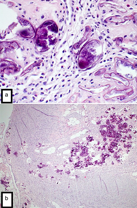 (a) H&E stain (4×) revealed the appendix shows focal transmural deposition of calcified Bilharizial ova on the background of acute suppurative appendicitis with periappendicitis. (b) H&E stain (40×) revealed the appendix shows focal transmural deposition of calcified Bilharizial ova on the background of acute suppurative appendicitis with periappendicitis.
