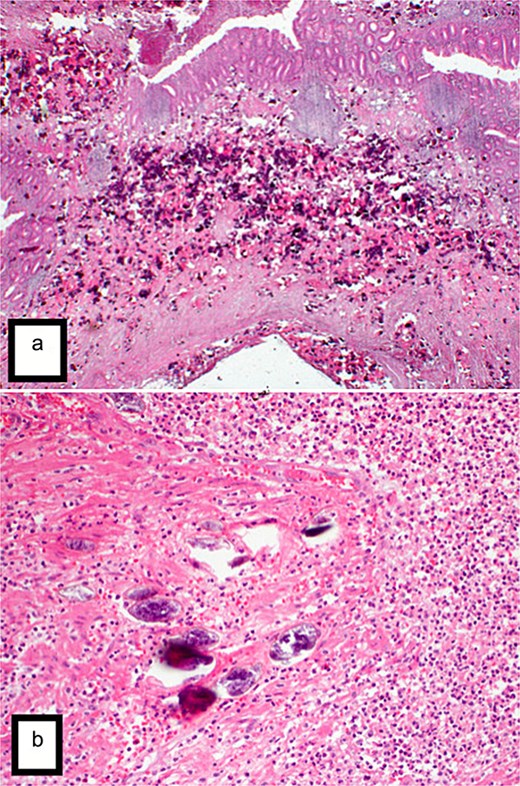 (a) H&E stain (2×) revealed the appendix shows extensive transmural deposition of calcified Bilharizial ova on the background of acute suppurative appendicitis with periappendicitis. (b) H&E stain (20×) revealed the appendix shows extensive transmural deposition of calcified Bilharizial ova on the background of acute suppurative appendicitis with periappendicitis.