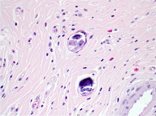 H&E stain (40×) revealed the appendix shows focal submucosal deposition of Bilharizial ova with focal granulomatous inflammation.