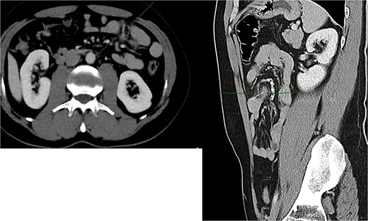 Contrast-enhanced CT scan showing ~3 cm radiopaque linear foreign body lodged within a jejunal loop, penetrating the bowel wall into adjacent mesenteric fat.
