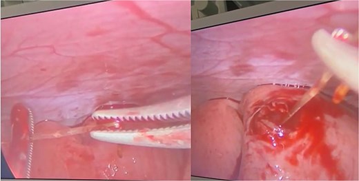 Intraoperative laparoscopic view demonstrating a sharp foreign body—later confirmed as a ~3 cm fish bone—was seen protruding through the antimesenteric border into the mesenteric fat.