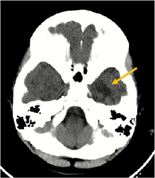Axial non-contrast CT scan of the brain. This image demonstrates an ill-defined hypodensity (arrow) in the left inferior temporal lobe (seen as a darker area). No acute intracranial hemorrhage or fracture was identified at the time of this initial scan.
