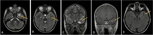 Axial lower cut (A)/axial higher cut (B)/coronal (C) T2-weighted MRI of the brain shows a prominent area of T2 hyperintensity (arrow) in the white matter of the left anterior temporal lobe, adjacent to the DVA. The DVA itself is clearly delineated on the contrasted sequence (D) and its draining veins contribute to the local anatomy (arrow). (E) Axial FLAIR (fluid-attenuated inversion recovery) highlights the abnormal hyperintensity in the left anterior temporal lobe white matter (arrow), suppressing the cerebrospinal fluid signal and making the white matter changes more conspicuous. This represents chronic changes such as gliosis or edema.