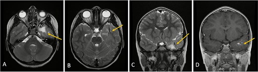 Axial lower cut (A)/axial higher cut (B)/coronal (C) T2-weighted MRI of the brain shows stable findings of a prominent area of T2 hyperintensity in the white matter of the left anterior temporal lobe, adjacent to the known DVA (arrow), which is clearly delineated on the contrasted sequence (D).