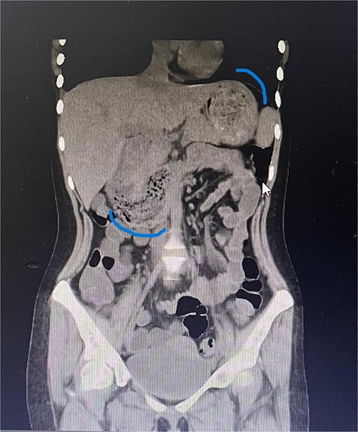 Sagittal CT image showing the foreign body occupying the gastric cavity and extending into the third and fourth portions of the duodenum.