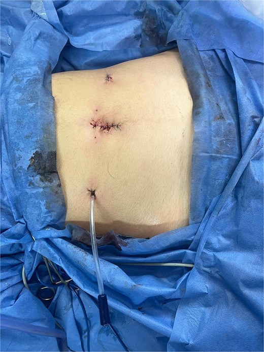 Final port placement at the end of the procedure, showing the tubular drain in situ.