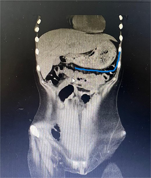 Sagittal CT image demonstrating the foreign body filling the entire gastric cavity.