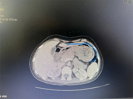 Axial CT image showing the foreign body completely occupying the gastric lumen.