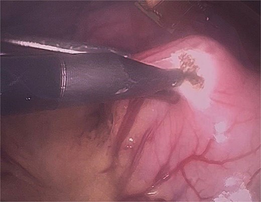 Initial gastrotomy beginning at the antral region and extending longitudinally toward the pylorus (without compromising it).