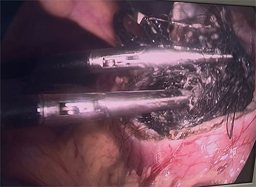 Identification of the bezoar after gastrotomy, revealing a large amount of contaminated trichobezoar material.