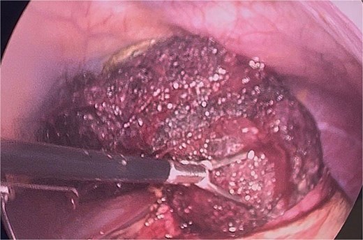 Bezoar extraction initiated from the duodenal region.