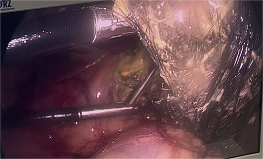 Final extraction of the bezoar from the gastric cavity and distal esophagus.