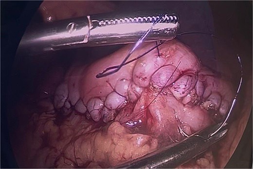 Final gastric closure using continuous single-layer suturing with 3–0 PDS on a round needle.