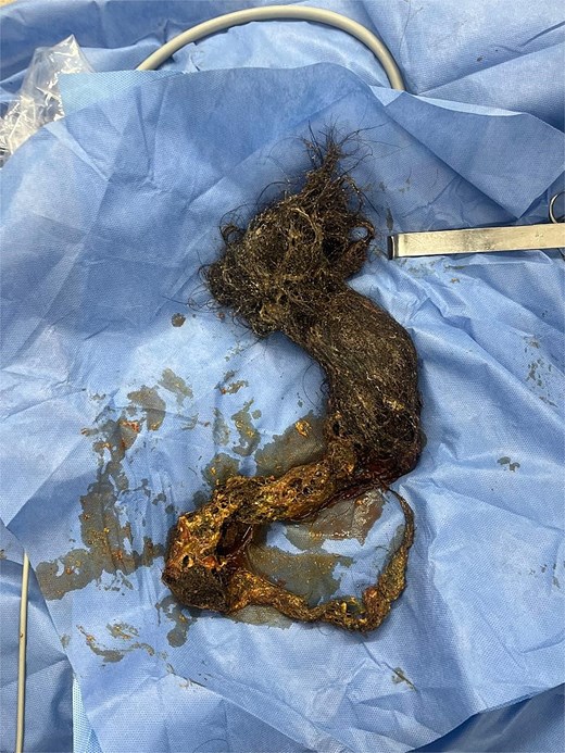 Surgical specimen of the bezoar.