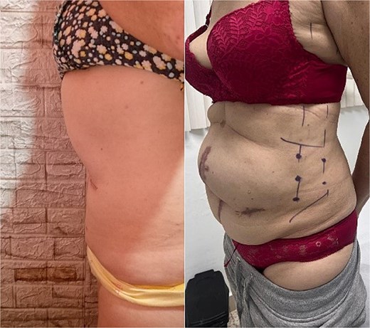 On the right, patient with preoperative marking for botulinum toxin application; on the left, postoperative appearance after component separation assisted by botulinum toxin.