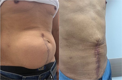 Preoperative image (left) of a patient with a 19 cm ventral hernia; on the right, postoperative result after repair with component separation and botulinum toxin use.
