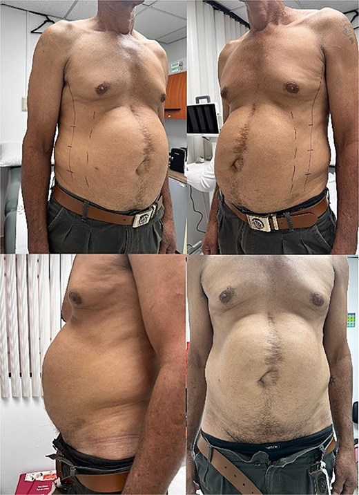 Patient with a giant ventral hernia larger than 23 cm, prepared for botulinum toxin application as a preoperative strategy to facilitate abdominal wall closure.