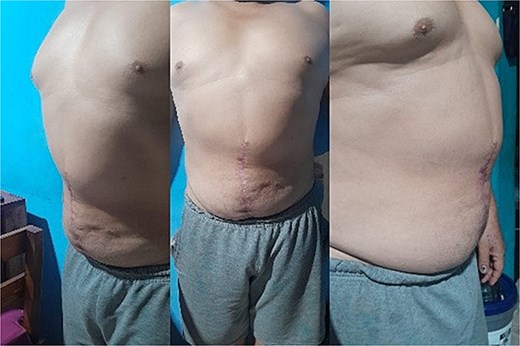 Postoperative result of a patient who underwent component separation with adjuvant botulinum toxin application, showing improved abdominal wall integrity.