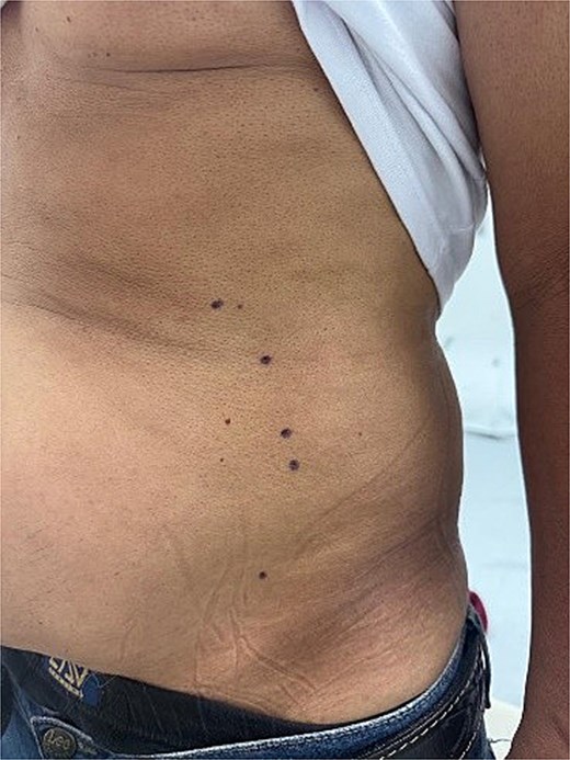 Marking on the abdominal wall of a patient candidate for botulinum toxin injection prior to ventral hernia repair.