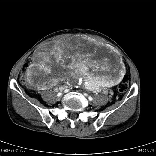 Contrast-enhanced CT showing a large tumour measuring 20 cm in diameter occupying both the abdominal and pelvic cavities.