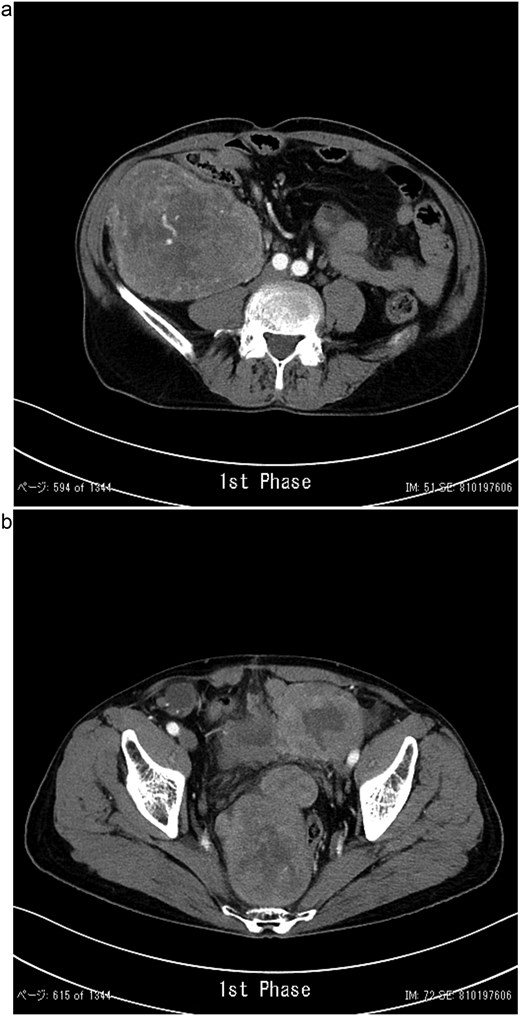 Contrast-enhanced CT showing a lobulated, ill-defined mass with heterogeneous moderate enhancement in the right lower abdomen (a) and several masses occupying the pelvic cavity (b).