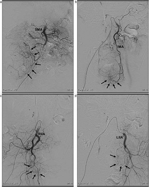 Angiographic findings. The large tumour (arrows) located in the right lower abdomen was supplied by a branch arising from the superior mesenteric artery (SMA) (a). The pelvic tumours (arrows) were supplied by branches arising from both the inferior mesenteric artery (IMA) (b) and the bilateral internal iliac arteries (RIIA and LIIA) (c and d).