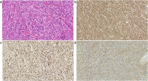 Pathological findings. Haematoxylin and eosin staining of the tumour showing spindle cells exhibiting a ‘patternless’ arrangement in a collagenous matrix (a). Immunohistochemical staining demonstrating that the tumour cells were positive for CD34 (b) and STAT6 (c), consistent with the diagnosis of a solitary fibrous tumour. Immunohistochemical staining showing positivity for insulin-like growth factor -II (IGF-II) in the tumour cells (d).