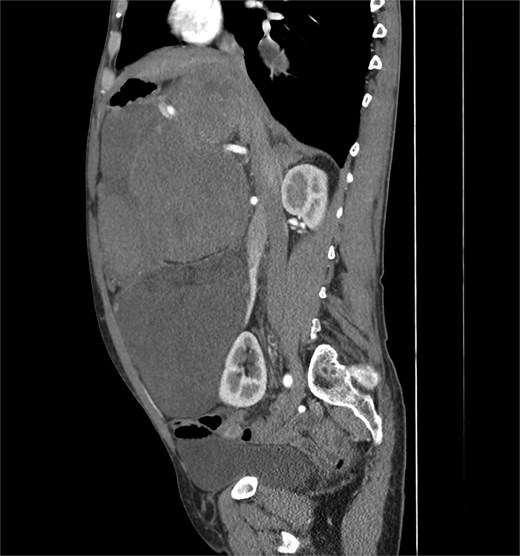 Coronal CT scan.