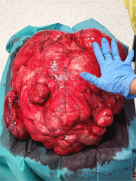 Intraoperative photograph of the retroperitoneal mass.