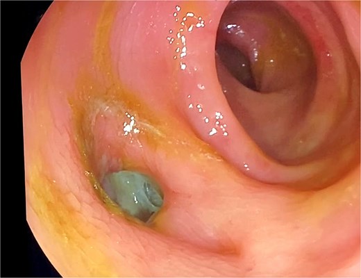 The colonoscopy finding shows a rectal diverticulum with a necrotic bottom.
