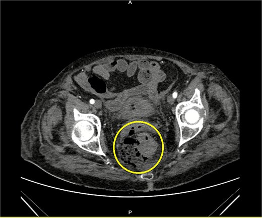 Contrast-enhanced CT of the pelvis showing free air around the rectum with a visible defect of the rectal wall (encircled).