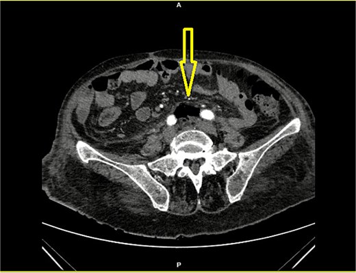 Contrast-enhanced CT of the abdomen showing retroperitoneal air (arrow) below the aortic bifurcation (between the common iliac arteries).
