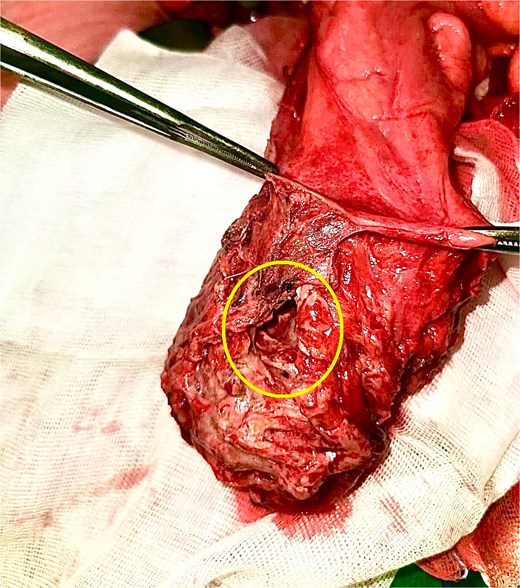 Operative specimen with free extraperitoneal rectal perforation (instruments holding the peritoneal reflection).