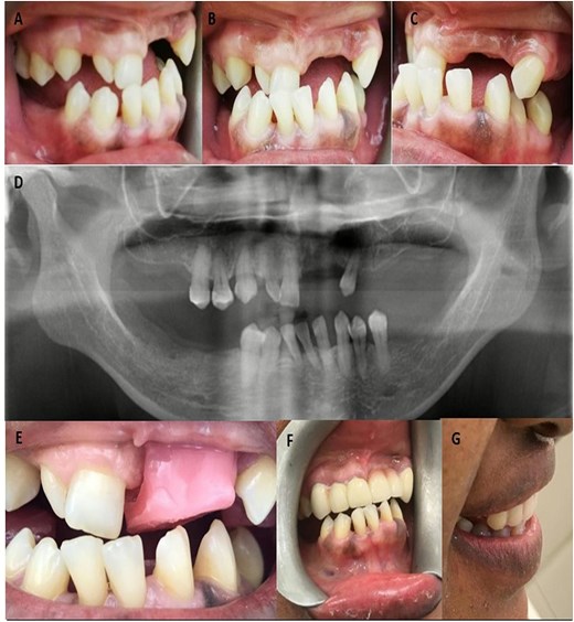 (A) Right lateral view of bite; (B) Front view of bite; (C) Left lateral view of bite; (D) Orthopentomogram after removal of six unit bridge on maxillary anterior teeth; (E) Jaw relation record with raised bite; (F and G) Front and side view after fixed and removable denture insertion.