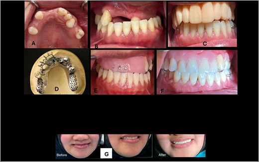 (A) Maxillary arch occlusal view; (B) Frontal view showing class III and loss of occlusal vertical dimension; (C) Prototype of overlay removable partial denture; (D) Cast partial denture framework; (E) Jaw relation record; (F) Definitive overlay removable partial denture; (G) Before and after photographs of the patient.