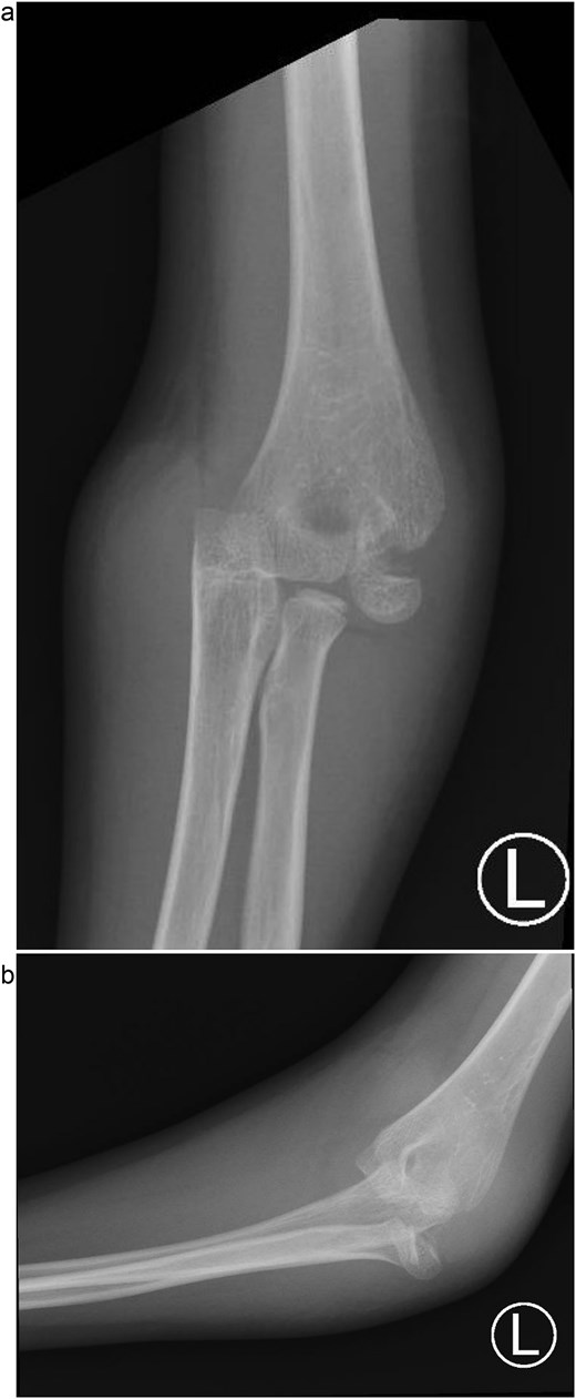 (a) Pre-reduction anteroposterior radiograph of the left elbow showing posteromedial dislocation of the ulnohumeral joint with displaced lateral humeral condyle fracture. (b) Lateral radiograph demonstrating posterior displacement of the olecranon and lateral condyle fragment.