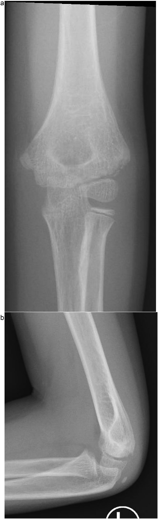 (a) Immediate post-reduction anteroposterior radiograph showing restored joint alignment with persistent lateral condyle displacement. (b) Lateral view confirming maintained reduction of the ulnohumeral joint and residual separation of the lateral condyle fragment.