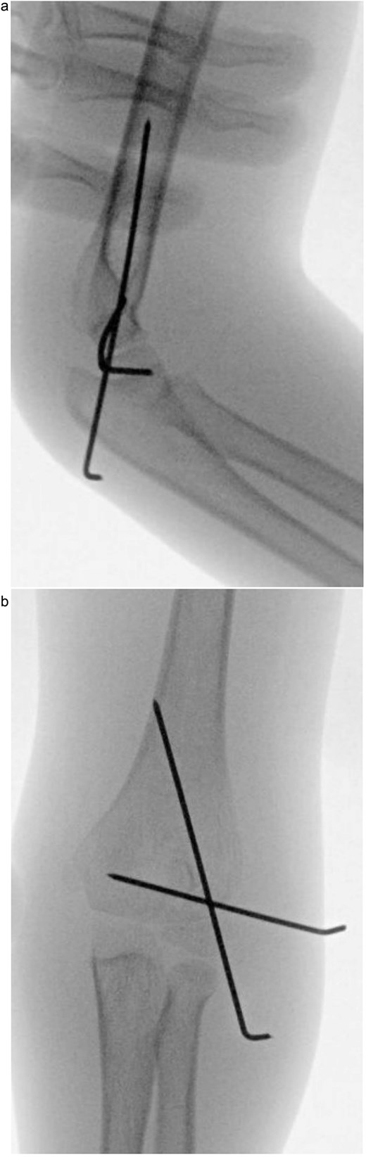 (a) Intraoperative fluoroscopic image following closed reduction and K-wire fixation showing anatomical alignment of the lateral condyle. (b) Arthrogram confirming a congruent articular surface and stable fixation of the fracture fragment.