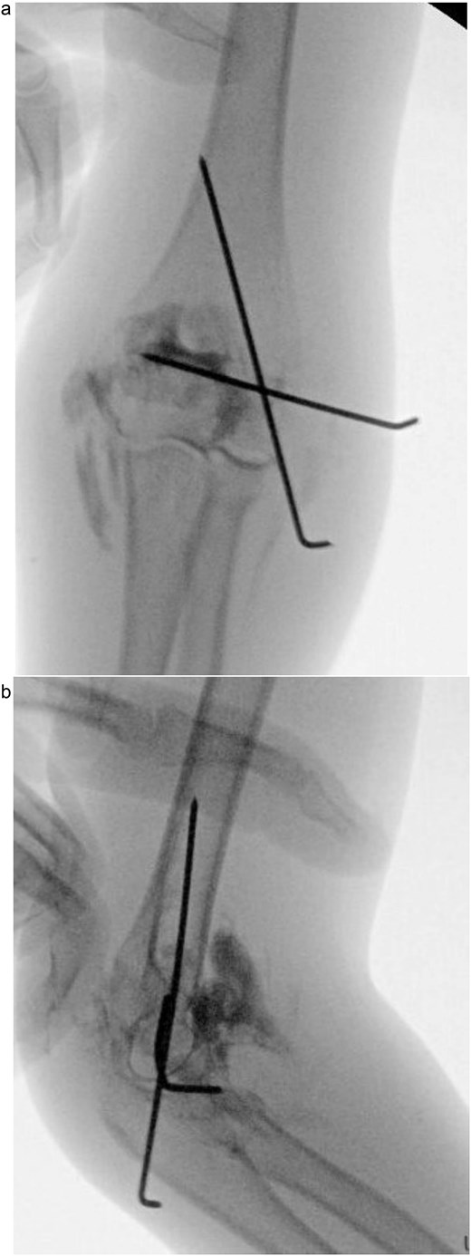 (a) Postoperative anteroposterior radiograph demonstrating stable fixation of the lateral condyle with two smooth Kirschner wires. (b) Lateral view showing proper wire placement and a well-aligned elbow maintained in a posterior slab splint.