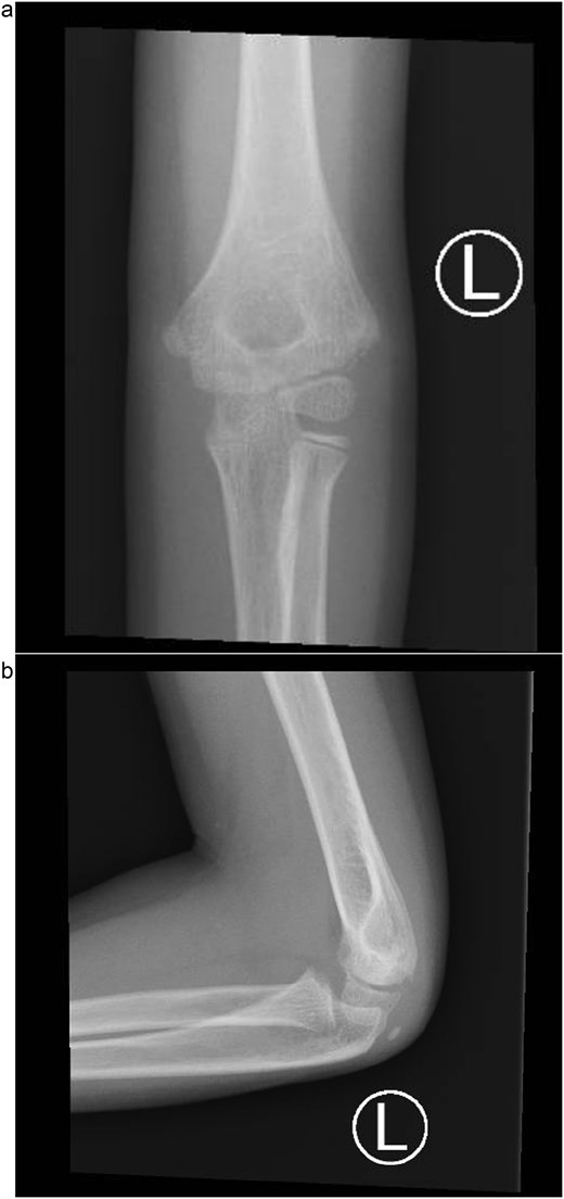 (a) Six-month follow-up anteroposterior radiograph showing complete union of the lateral condyle fracture after Kirschner wire removal. (b) Six-month lateral radiograph demonstrating full healing with restored joint alignment, maintained carrying angle, and no evidence of growth disturbance or deformity.
