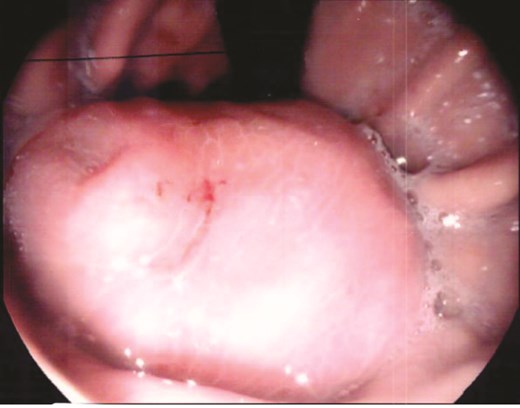 Gastroscopy identified a large submucosal mass in the gastric fundus.