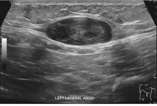 Abdominal US showed a well-defined soft tissue mass attached to the left inferior aspect of the rectus muscle.