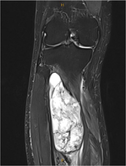 MRI showed a large tibialis posterior intramuscular lesion with proximal tibial involvement.