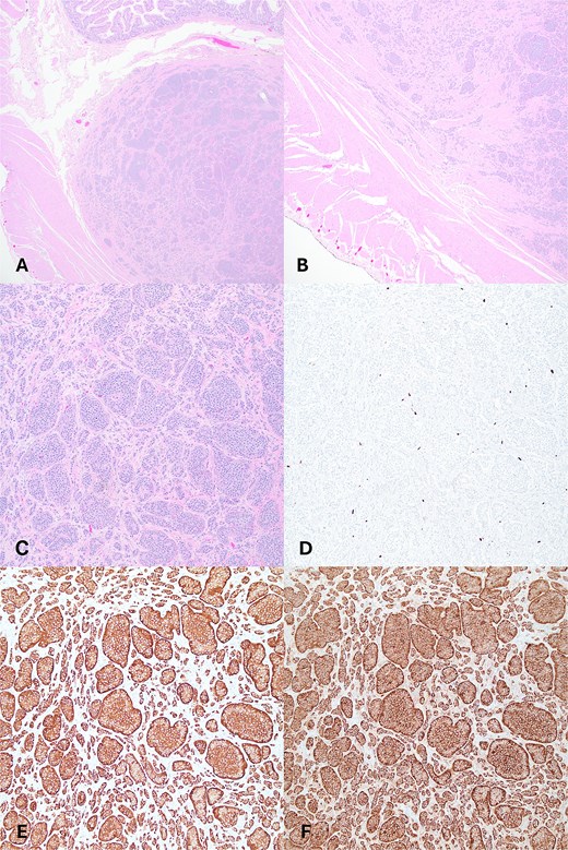 (A) Tumor present in submucosa of Meckel’s diverticulum, H&E 20x. (B) Tumor with microscopic invasion of muscularis propria, H&E, 40x. (C–F) Tumor shows well-differentiated neuroendocrine cells with organoid growth pattern (C), low Ki67 proliferation pattern (D), immunohistochemistry positivity for chromogranin (E), synaptophysin (F); (A–F) 100x.