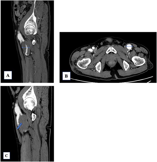 (A) The left profunda femoris artery aneurysm (PFAA) measures 32 mm. A large thrombus is observed. The peripheral vessels are patent. (B) The common femoral artery aneurysm (28 mm) shows a mural thrombus, and the left PFAA is enlarged to 35 mm. (C) The PFAA is completely occluded by the thrombus.